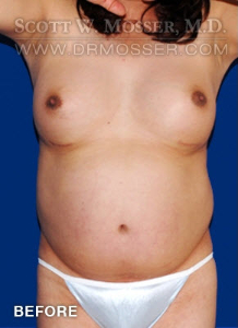Liposuction - Abdomen & Flanks Patient 68884 Before Photo # 1