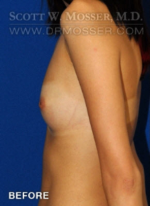 Breast Augmentation Patient 18496 Before Photo # 5