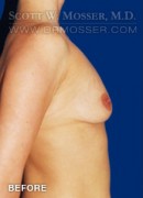 Breast Augmentation Patient 40416 Before Photo Thumbnail # 3