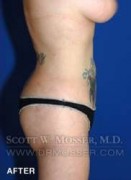 Liposuction - Abdomen & Flanks Patient 81638 After Photo Thumbnail # 8