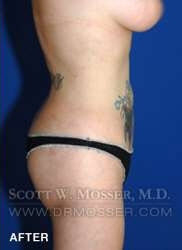 Liposuction - Abdomen & Flanks Patient 81638 After Photo # 8