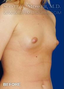 Breast Augmentation Patient 61622 Before Photo # 3