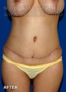 Abdominoplasty Patient 81038 After Photo Thumbnail # 2