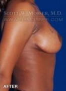 Breast Lift Without Implants Patient 95927 After Photo Thumbnail # 6
