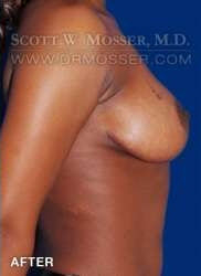 Breast Lift Without Implants Patient 95927 After Photo # 6