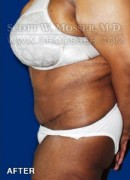 Abdominoplasty Patient 30014 After Photo Thumbnail # 4