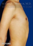 Breast Augmentation Patient 50236 Before Photo Thumbnail # 5