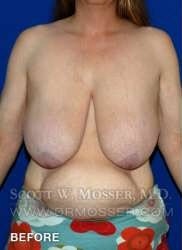Breast Reduction Patient 97519 Before Photo # 7