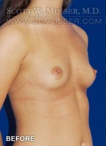 Breast Augmentation Patient 36235 Before Photo # 3