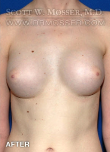 Breast Augmentation Patient 21498 After Photo # 2