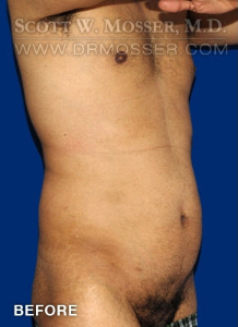 Liposuction - Chest Patient 51091 Before Photo # 9