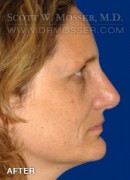Rhinoplasty Patient 48032 After Photo Thumbnail # 4