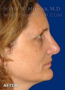 Rhinoplasty Patient 48032 After Photo # 4