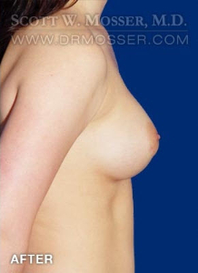 Breast Augmentation Patient 36235 After Photo # 6