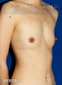 Breast Augmentation Patient 25809 Before Photo # 3