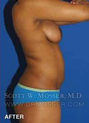 Liposuction - Abdomen & Flanks Patient 11942 After Photo # 8