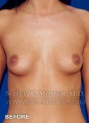 Breast Augmentation Patient 87318 Before Photo Thumbnail # 1