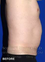 Liposuction - Abdomen & Flanks Patient 64992 Before Photo # 7