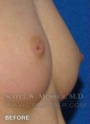 Nipple Inversion Correction Patient 70533 Before Photo Thumbnail # 5