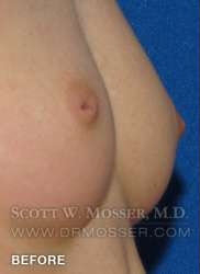 Nipple Inversion Correction Patient 70533 Before Photo # 5