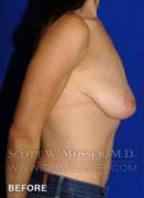 Breast Lift With Implants Patient 19074 Before Photo Thumbnail # 7