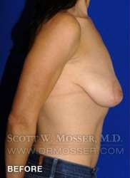 Breast Lift With Implants Patient 19074 Before Photo # 7