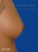 Nipple Inversion Correction Patient 38571 After Photo Thumbnail # 4