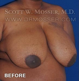 Breast Reduction Patient 91361 Before Photo # 3