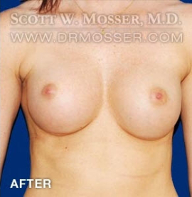Breast Augmentation Patient 41756 After Photo # 2