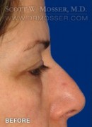 Brow Lift Patient 82649 Before Photo Thumbnail # 3
