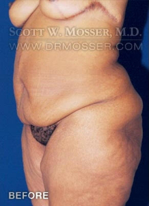 Lower Body Lift Patient 16603 Before Photo # 3