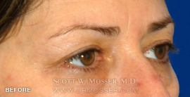 Lower Blepharoplasty Patient 88372 Before Photo # 3
