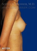Breast Augmentation Patient 68907 After Photo Thumbnail # 6