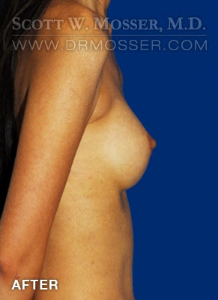 Breast Augmentation Patient 68907 After Photo # 6