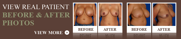 breast_reduction