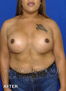 MTF Breast Augmentation Patient 18318 After Photo # 2