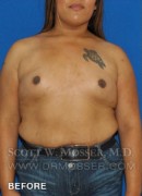 MTF Breast Augmentation Patient 18318 Before Photo Thumbnail # 1