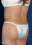 Body Contouring Patient 42004 After Photo Thumbnail # 12