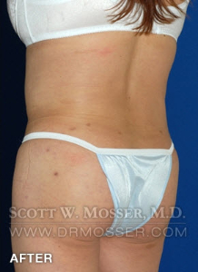 Body Contouring Patient 42004 After Photo # 12