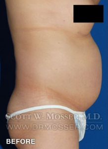 Body Contouring Patient 42004 Before Photo # 7