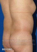 Body Contouring Patient 42004 Before Photo Thumbnail # 13