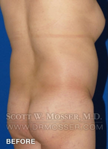 Body Contouring Patient 42004 Before Photo # 13