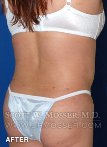 Body Contouring Patient 42004 After Photo # 14