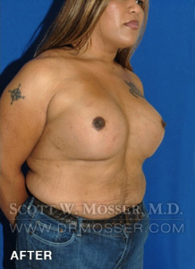 MTF Breast Augmentation Patient 18318 After Photo # 4