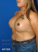 MTF Breast Augmentation Patient 18318 After Photo Thumbnail # 6