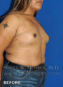 MTF Breast Augmentation Patient 18318 Before Photo # 3