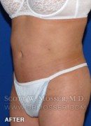 Body Contouring Patient 42004 After Photo Thumbnail # 4
