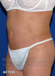 Body Contouring Patient 42004 After Photo # 4
