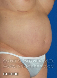 Body Contouring Patient 42004 Before Photo # 5