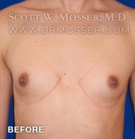 MTF Breast Augmentation Patient 69514 Before Photo # 1